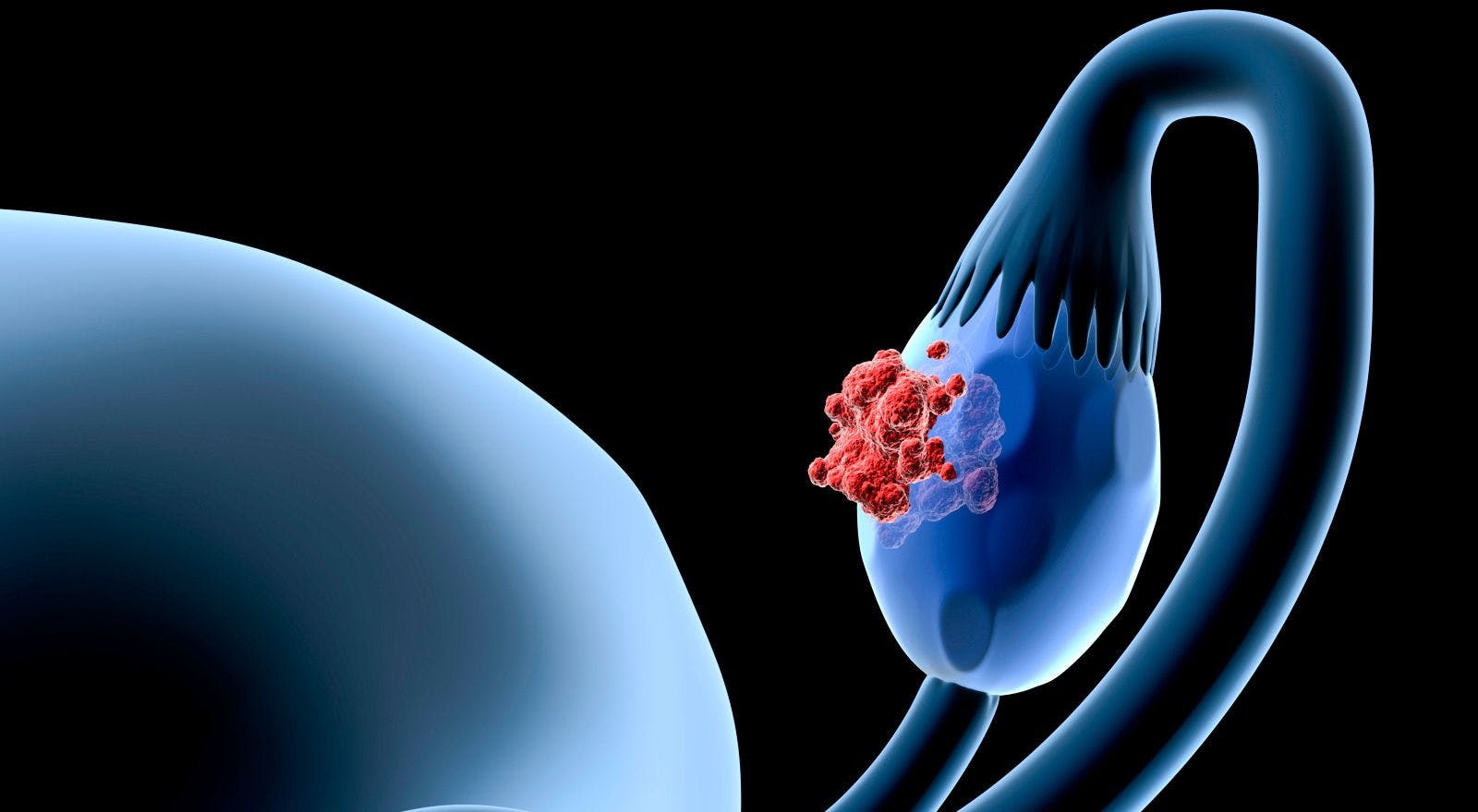 Neoadjuvant Therapy Becoming More Popular in Ovarian Cancer Treatment