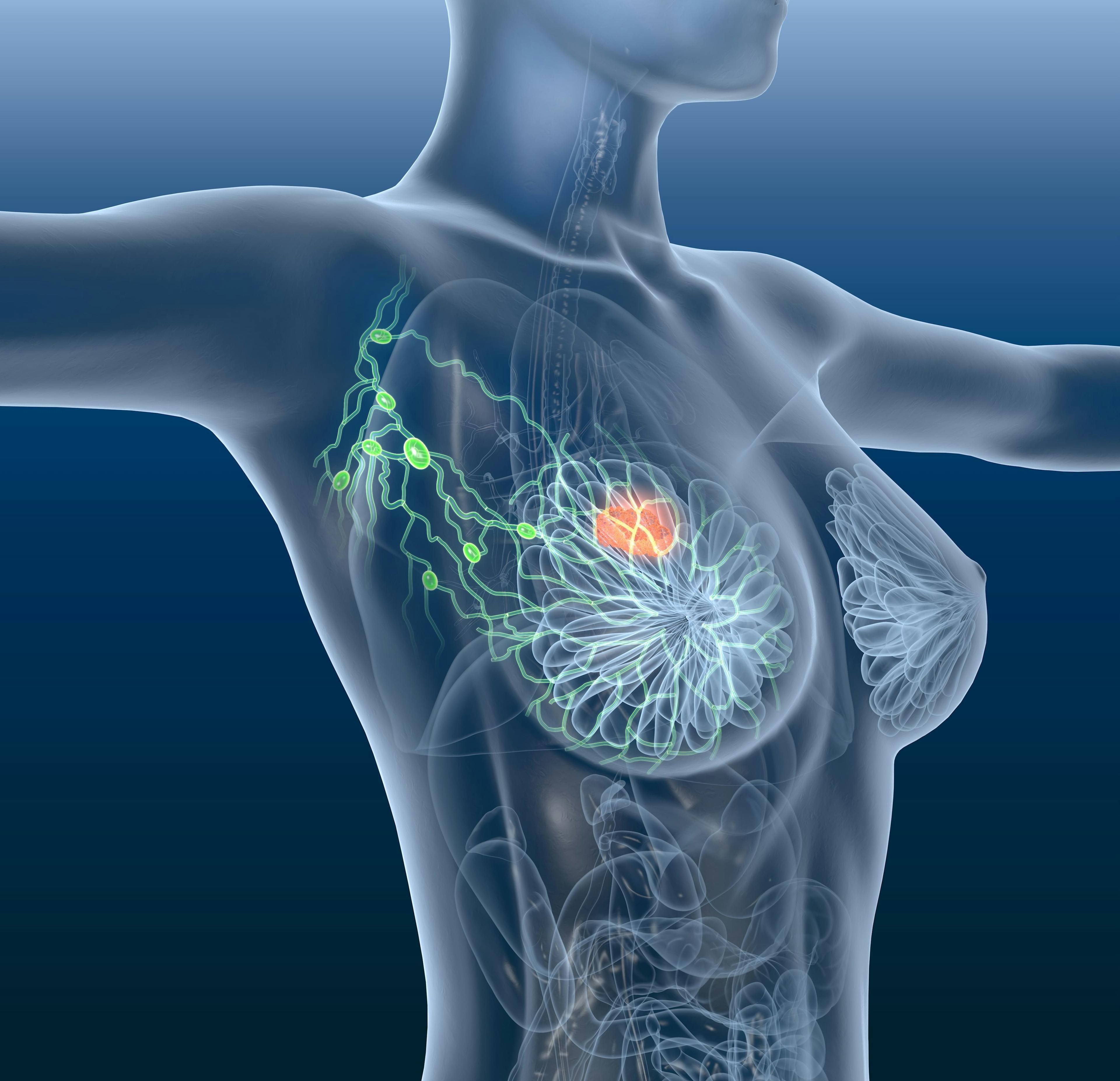 Understanding Radiation Therapy as a Patient with Breast Cancer