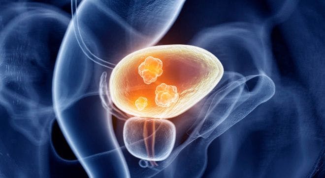 Radical Cystectomy: Risk Versus Reward for Patients With Bladder Cancer