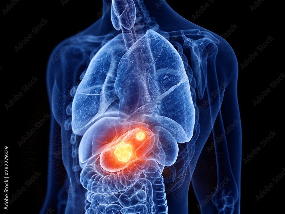 Image of a person with tumors in the stomach.