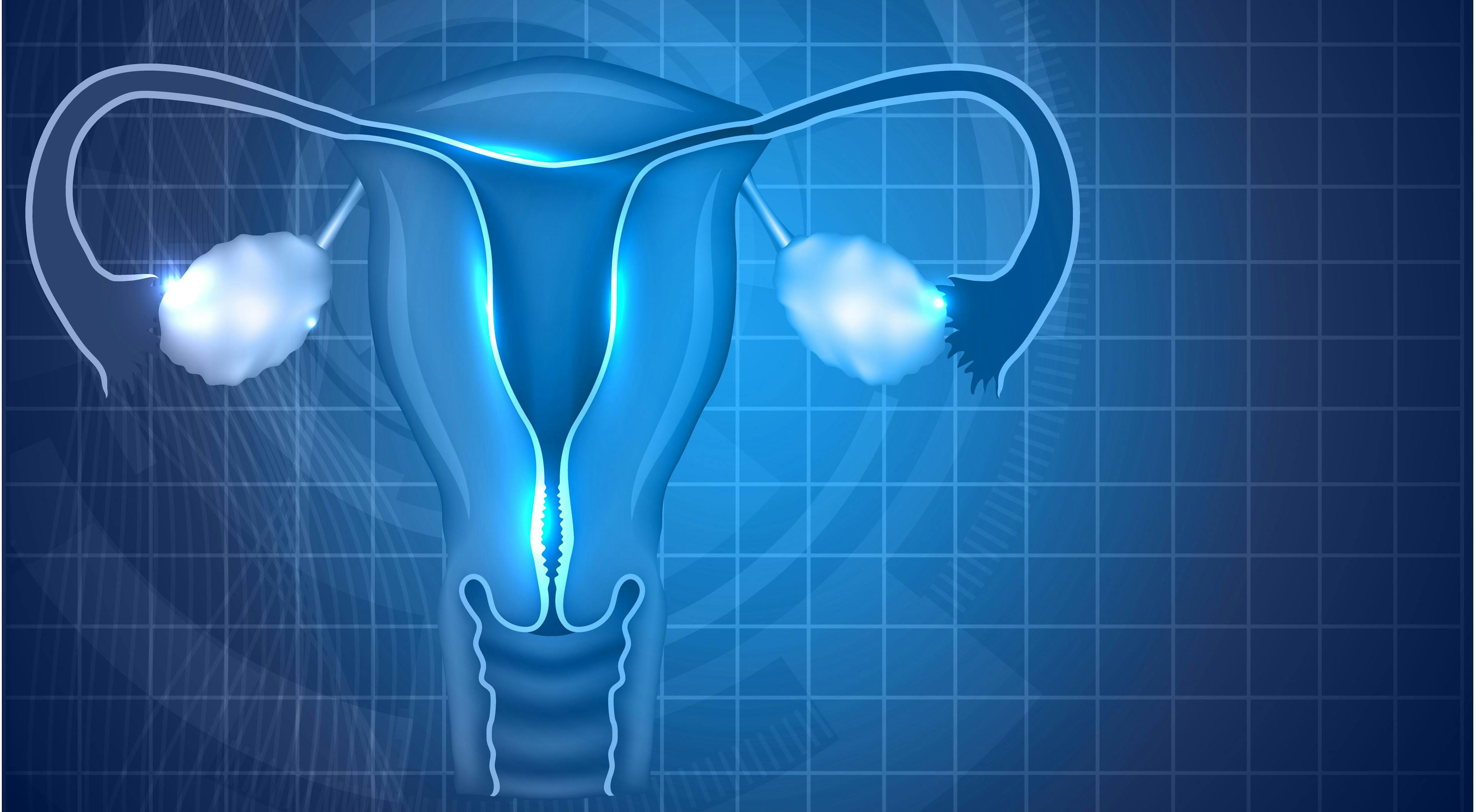 PARP Inhibitors Continue to Impress in the Ovarian Cancer Space