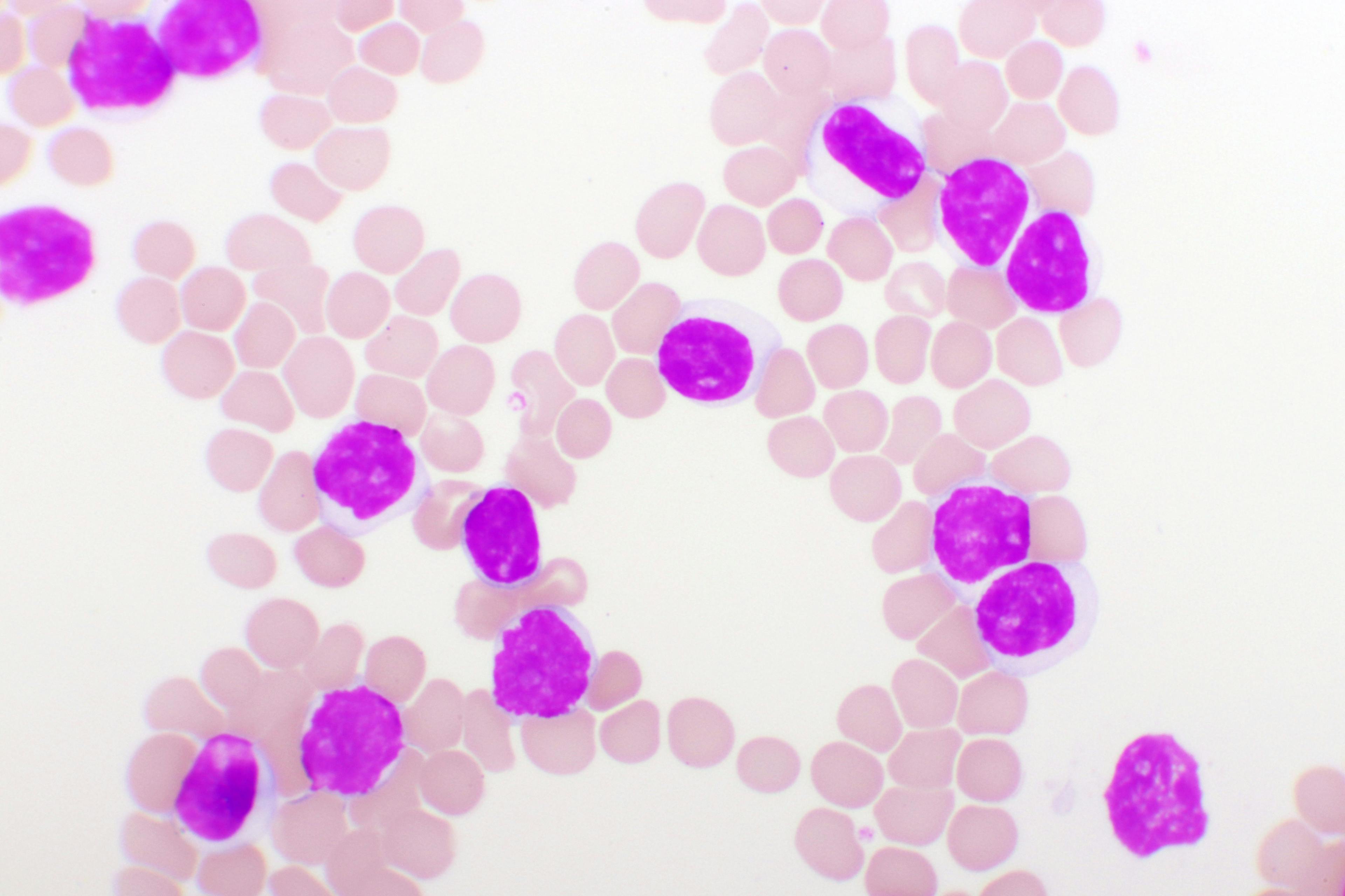 Front-Line Imbruvica-Venclexta Combo May Induce Durable Responses in Chronic Lymphocytic Leukemia and Small Lymphocytic Lymphoma