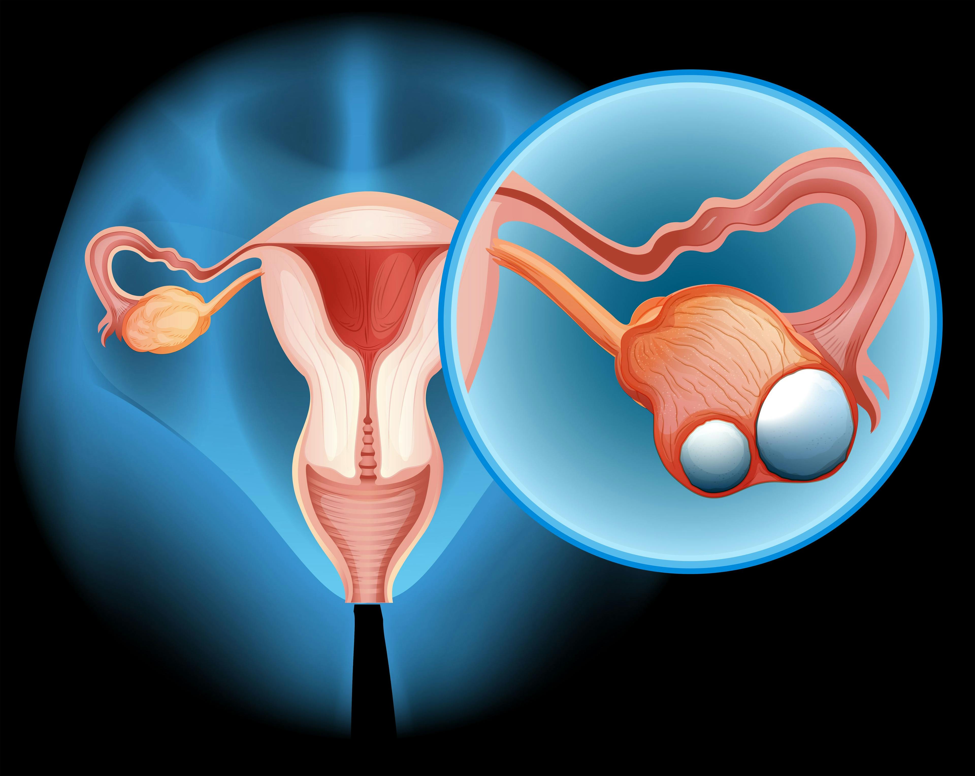 Image of ovaries and other parts of the reproductive system with ovaries and cancer highlighted.