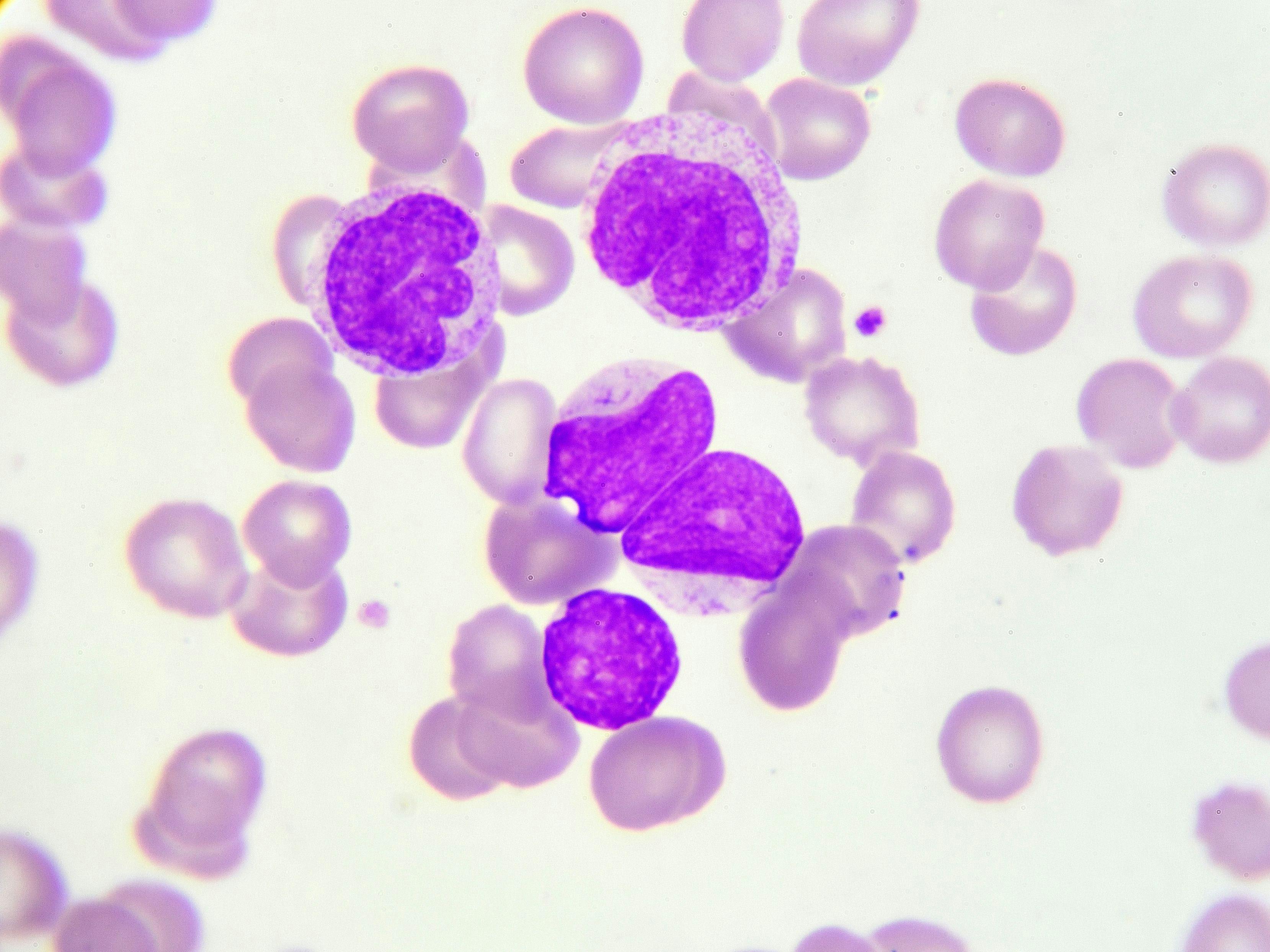 The Latest News and Updates in Acute Myeloid Leukemia