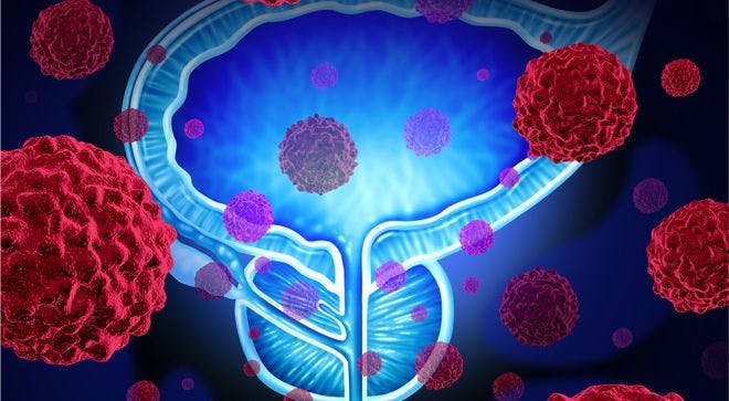 cancer cells surround a prostate gland. The treatment combination of Lynparza and Zytiga boosts progression-free survival in patients with metastatic prostate cancer.