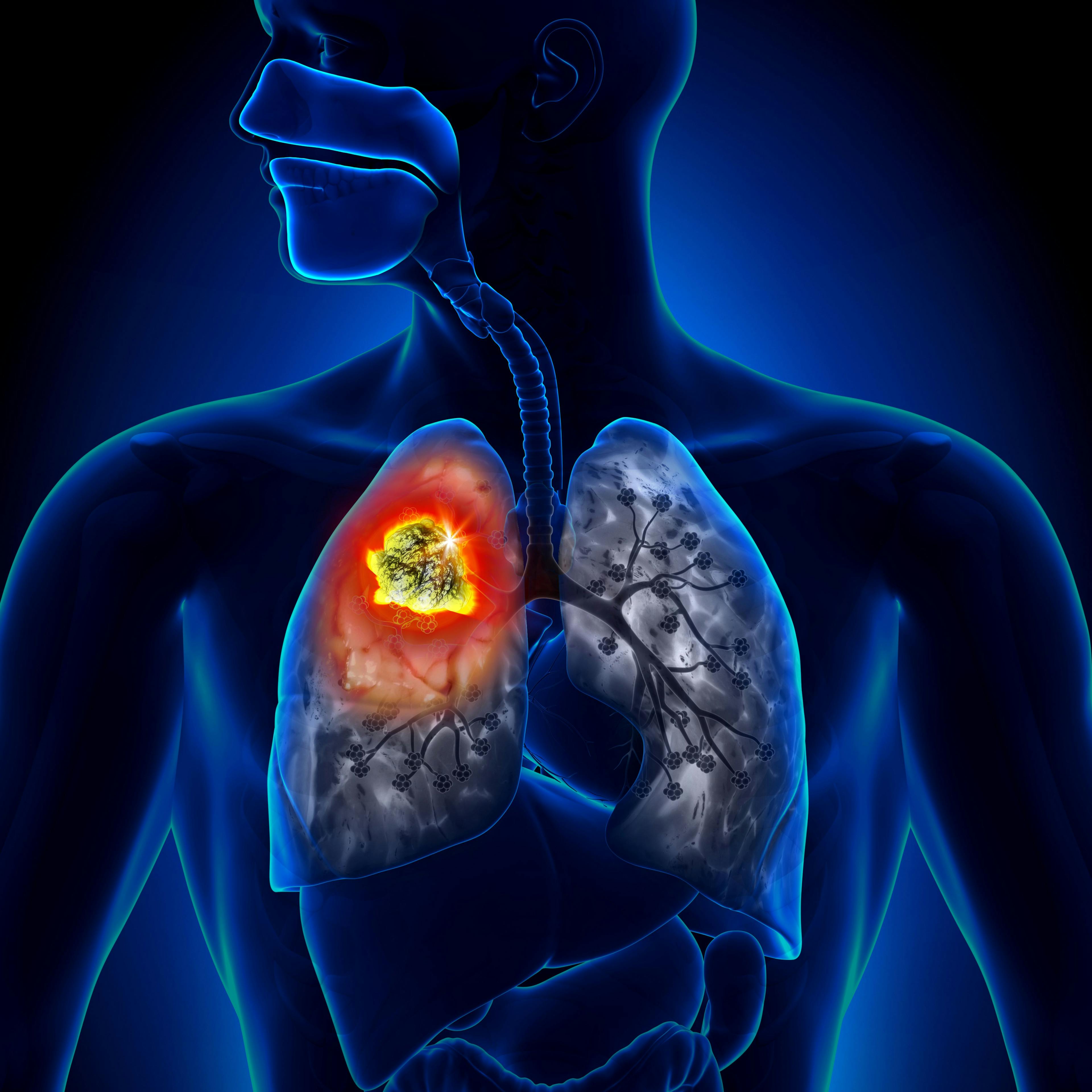 Lumakras Improves Outcomes, Quality of Life in Patients With Lung Cancer Subtype