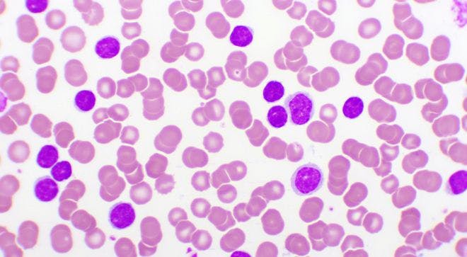 Cells depicting AML as pink and purple cells